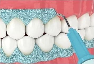Gingival barrier protecting the gums