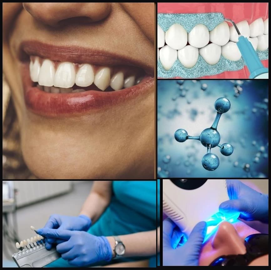 Smile result, shade matching, gingival barrier, whitening science, and LED light